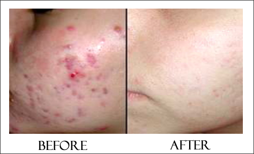 chemical peels for acne scars earlier than and after